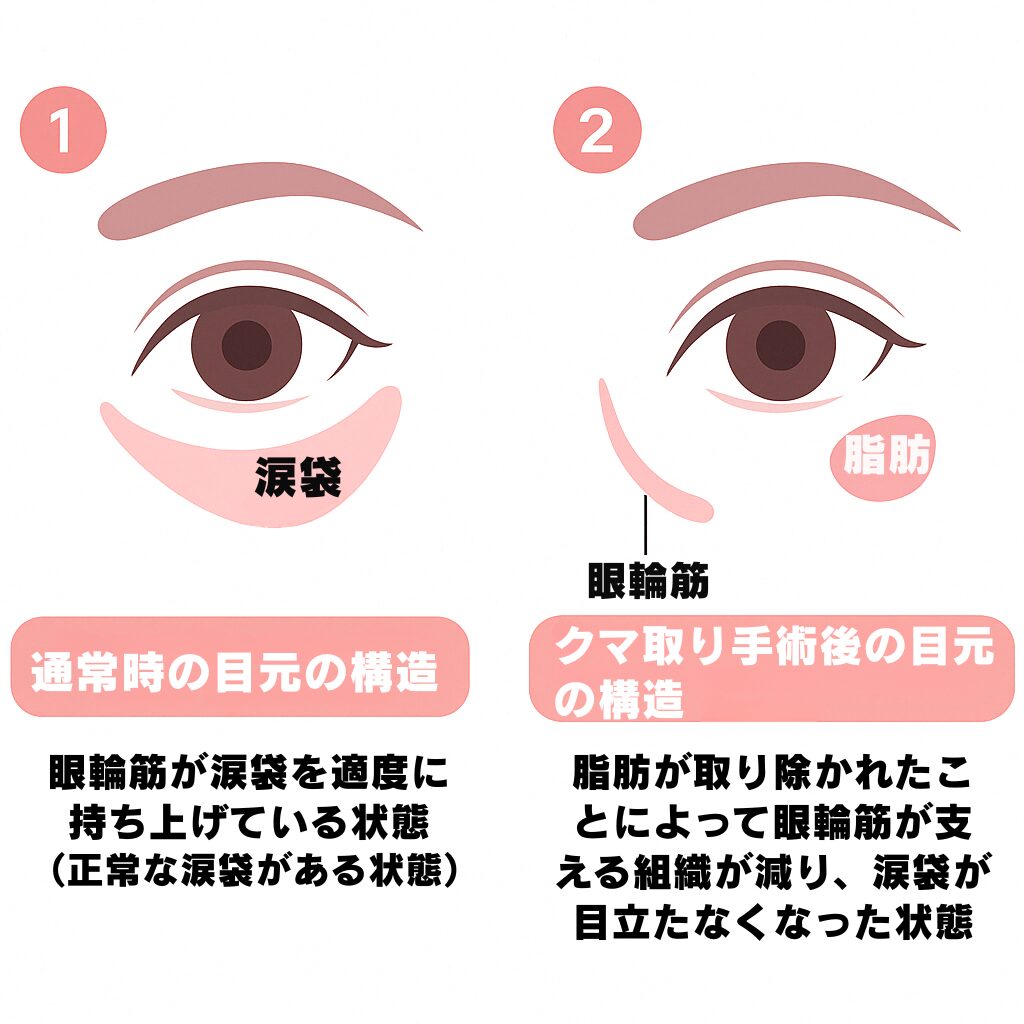 クマ取り手術後の涙袋目元の構造を描いたイメージ画像